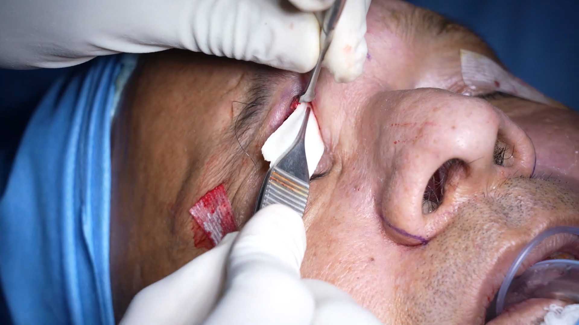 lower Jaw, Scar Revision Surgery